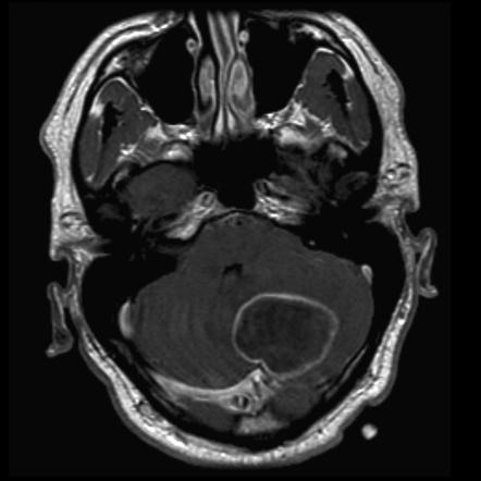 Pilocytic astrocytoma | Radiology Reference Article | Radiopaedia.org