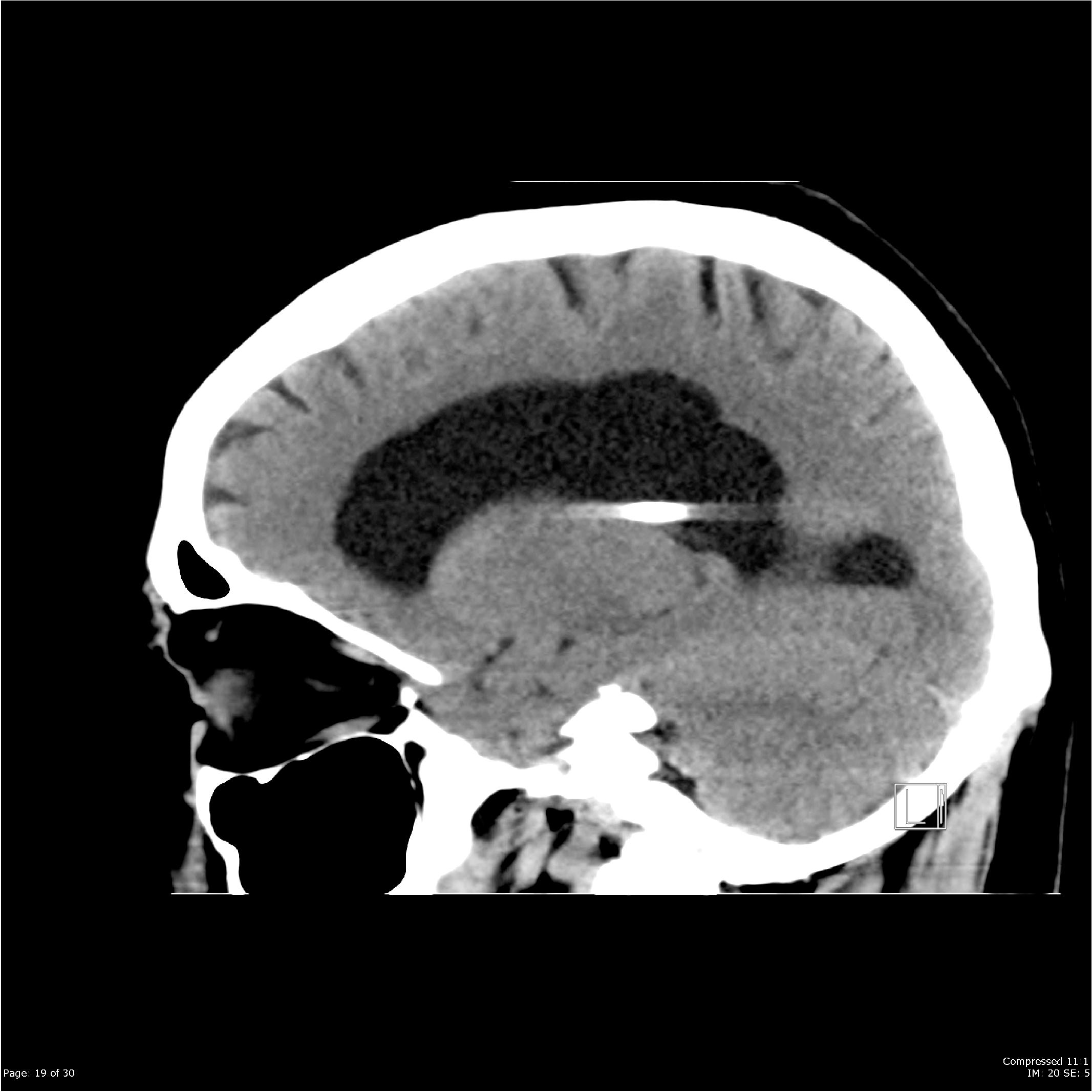 Normal Pressure Hydrocephalus Image 5429