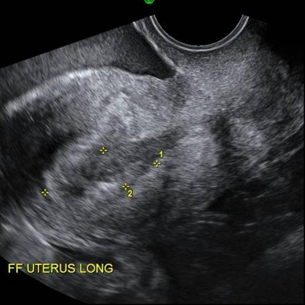 When an Ultrasound Shows a Heartbeat in Early Pregnancy