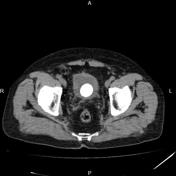 Bladder Calculus | Radiology Reference Article | Radiopaedia.org