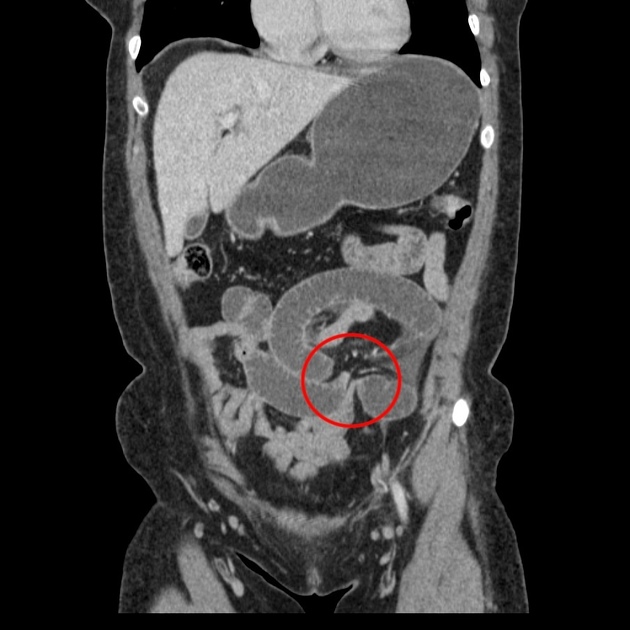 Closed loop obstruction Radiology Reference Article