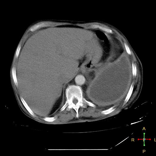 Thoracic empyema | Image | Radiopaedia.org