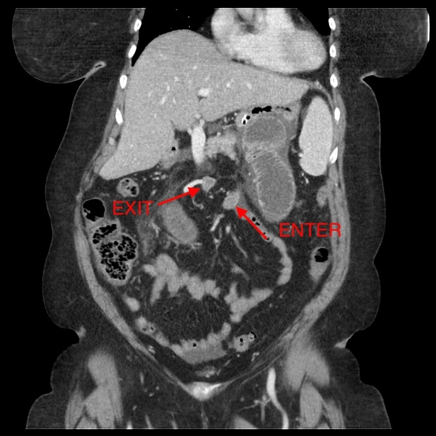 Closed loop obstruction Radiology Reference Article