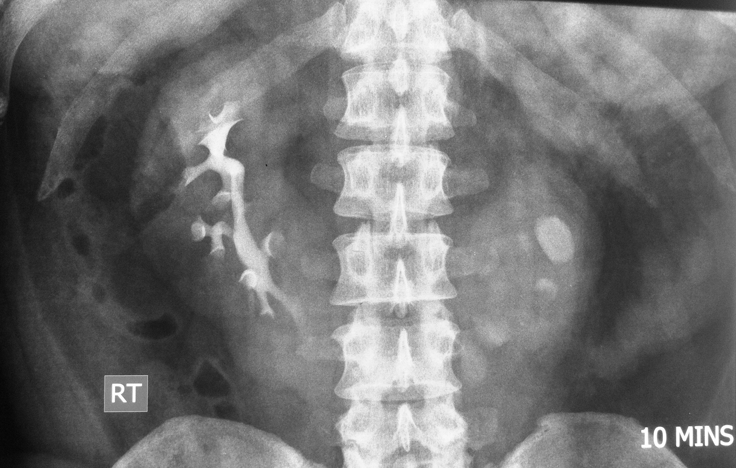 Horseshoe kidney with partial obstruction Image