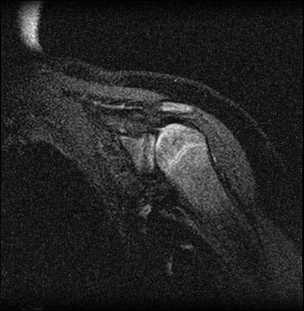 Glenohumeral dysplasia secondary to brachial plexus birth palsy | Image ...