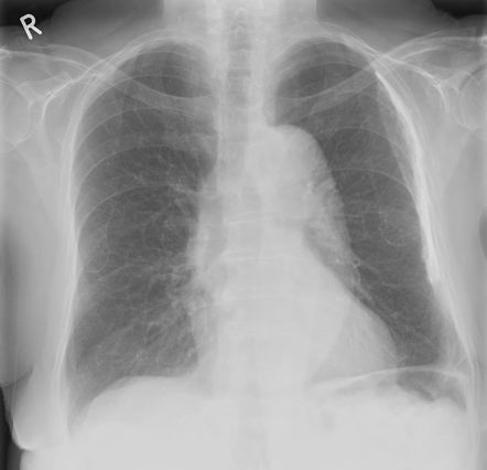 Pleural calcification | Radiology Reference Article | Radiopaedia.org