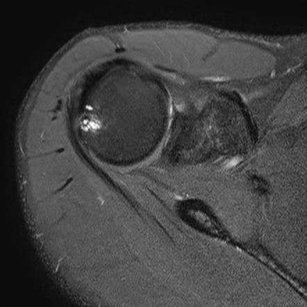 Internal store shoulder impingement