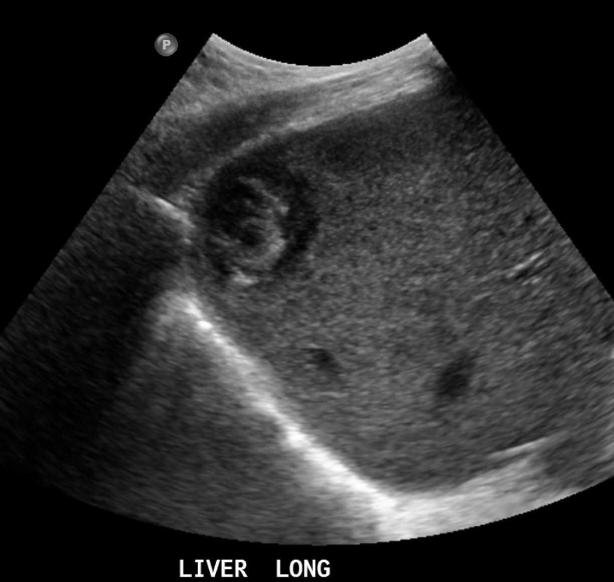 Hepatic Angiosarcoma 