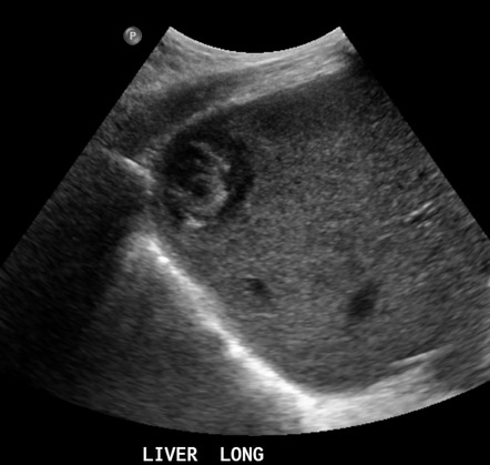 Hepatic angiosarcoma | Radiology Reference Article | Radiopaedia.org