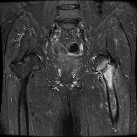 Subcapital femoral neck fracture | Image | Radiopaedia.org