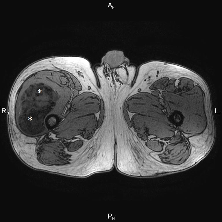 Myxoid Liposarcoma With Low Fat Content Image