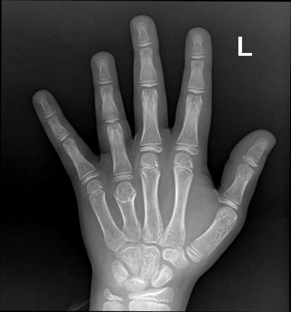 Fourth metacarpal bone hypoplasia | Radiology Case | Radiopaedia.org