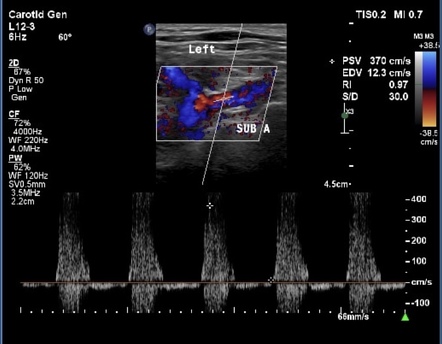 Common carotid artery occlusion with partial subclavian steal syndrome ...