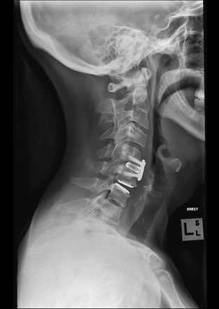 Normal cervical disc replacement and anterior cervical discectomy and ...