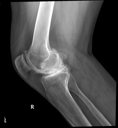 Crystal induced arthropathy (CPPD) | Image | Radiopaedia.org