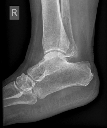 Ball and socket ankle joint | Image | Radiopaedia.org