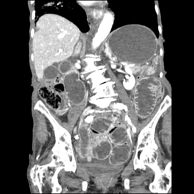 Obturator hernia causing small bowel obstruction | Image | Radiopaedia.org