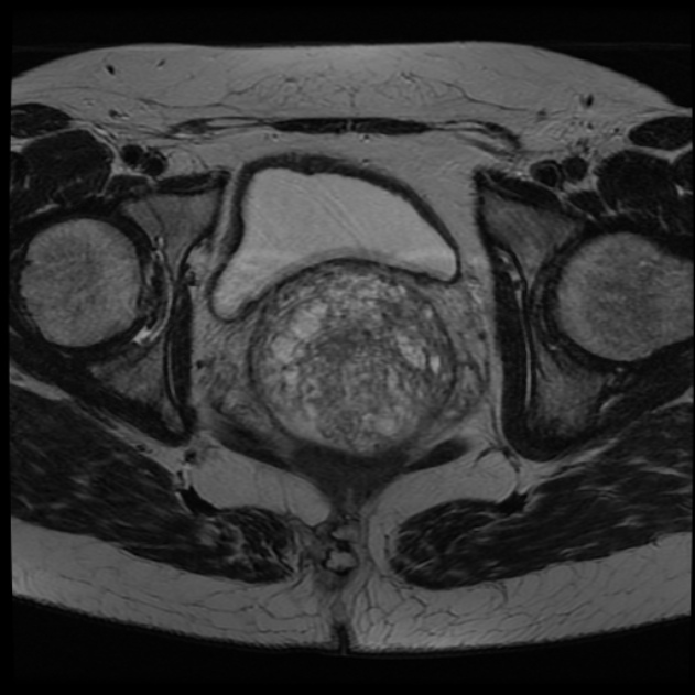 Adenoma Malignum Of The Cervix Image Radiopaedia Org