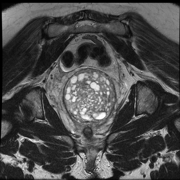 Adenoma Malignum Of The Cervix Image