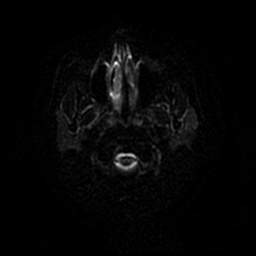 Polymicrogyria - peri-Sylvian fissure | Image | Radiopaedia.org