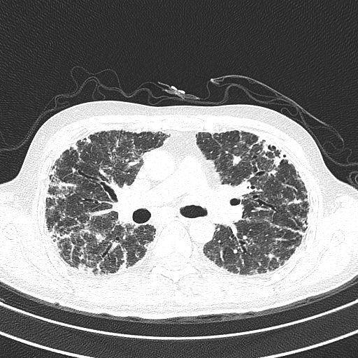 End-stage pulmonary sarcoidosis | Image | Radiopaedia.org