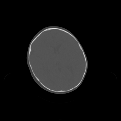 Unilateral Pterional Polycraniosynostosis 