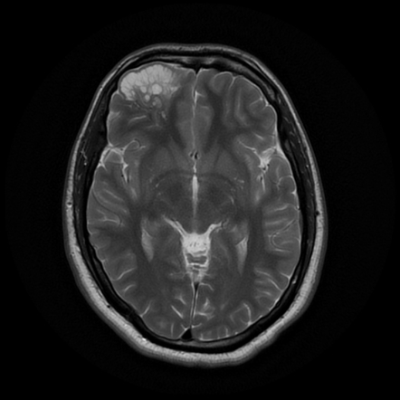 Giant Virchow-Robin spaces | Radiology Case | Radiopaedia.org