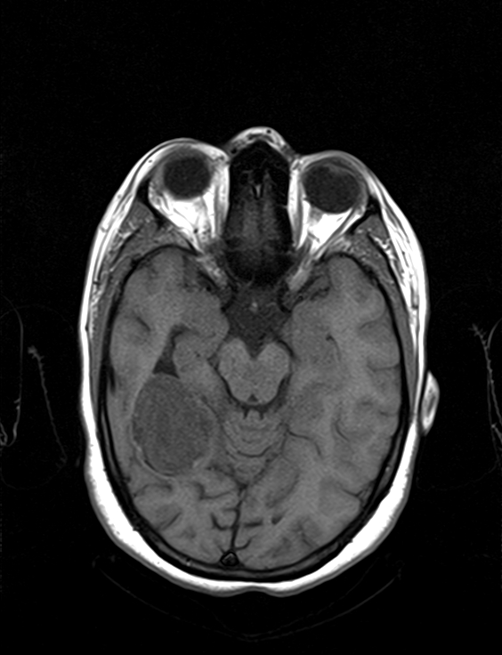 Calcified cerebral hydatid cyst | Image | Radiopaedia.org