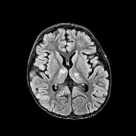 Status epilepticus | Radiology Case | Radiopaedia.org