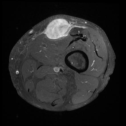 Myxofibrosarcoma | Radiology Case | Radiopaedia.org