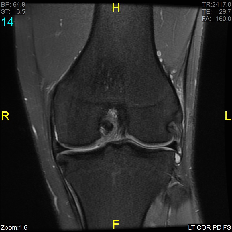 Iliotibial band syndrome | Image | Radiopaedia.org