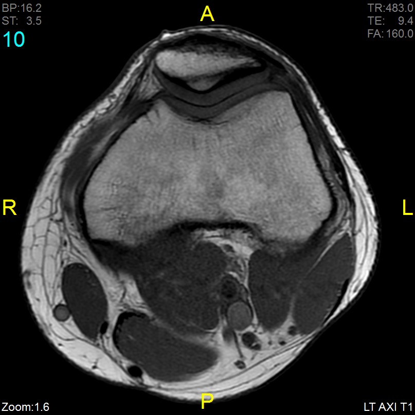 Iliotibial Band Syndrome | Image | Radiopaedia.org