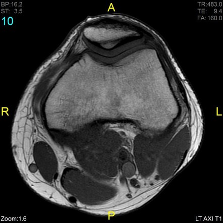 Iliotibial band syndrome | Image | Radiopaedia.org