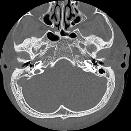 Semicircular canal dysplasia | Radiology Case | Radiopaedia.org