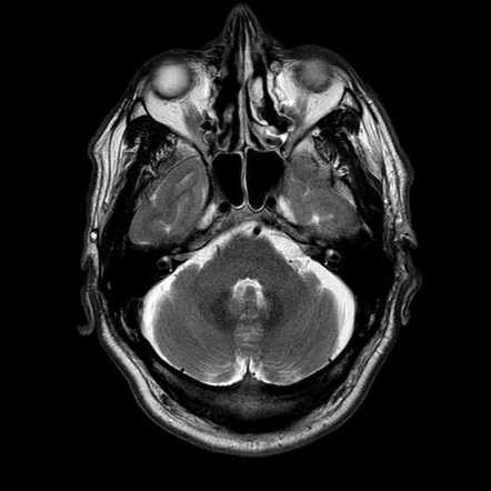 Internal acoustic canal lipoma | Image | Radiopaedia.org