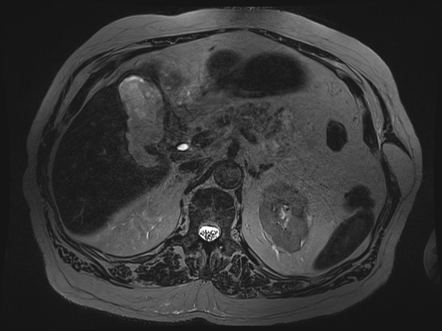 Gallbladder perforation | Image | Radiopaedia.org