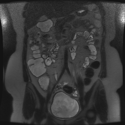 Enterovesical Fistula In Crohns Disease Image 