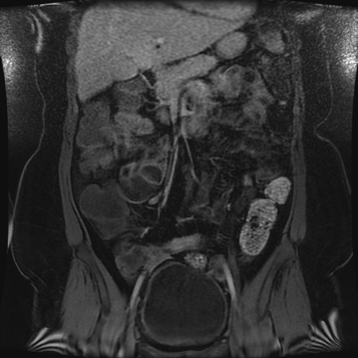 Enterovesical fistula in Crohn's disease | Image | Radiopaedia.org