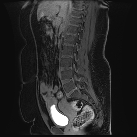 Uterovesical Fistula