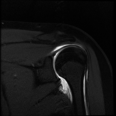 Humeral Avulsion Of The Glenohumeral Ligament (HAGL) | Radiology Case ...