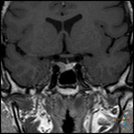 Pituitary Microadenoma Image