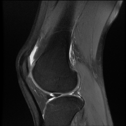 Double delta sign (meniscal tear) | Radiology Reference Article ...