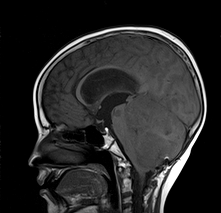 Leptomeningeal drop metastases - medulloblastoma | Radiology Case ...