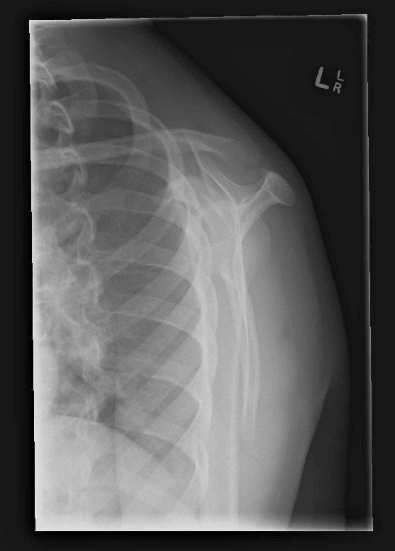 Osteomyelitis - proximal humerus | Image | Radiopaedia.org