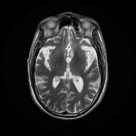 Frontotemporal lobar degeneration | Radiology Case | Radiopaedia.org