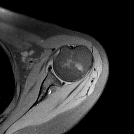 Adhesive Capsulitis - Shoulder | Image | Radiopaedia.org