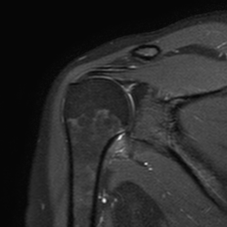 Adhesive capsulitis | Radiology Case | Radiopaedia.org