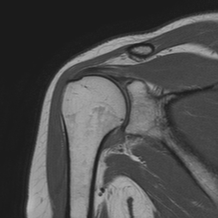 Adhesive capsulitis - shoulder | Image | Radiopaedia.org