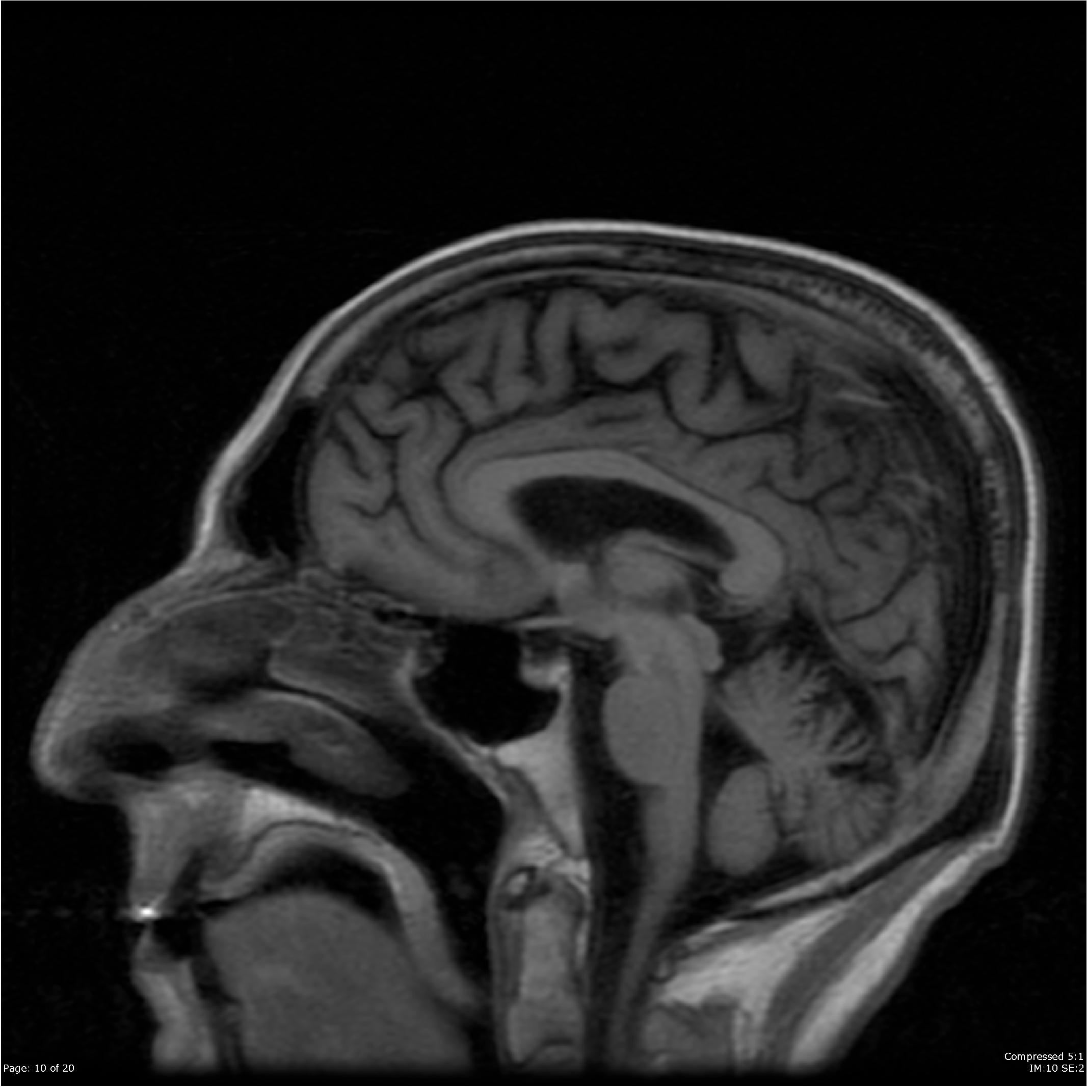 Hepatocerebral degeneration associated with heterozygous ...