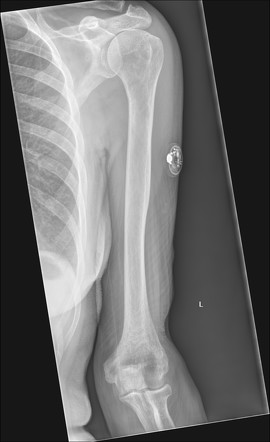 glucose monitor mri safety